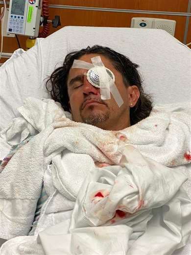 Jaime Moreno luego de la cirugía que le hicieron por el accidente que sufrió el lunes 13 de julio en Virginia, Estados Unidos. Foto: Orlando Durán