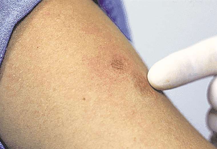 Los exantemas son característicos de este virus de la viruela símica / Foto: Imagen Referencial