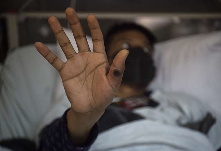 Bolivia tuvo su primer contagio de viruela confirmado el 1 de agosto /AFP