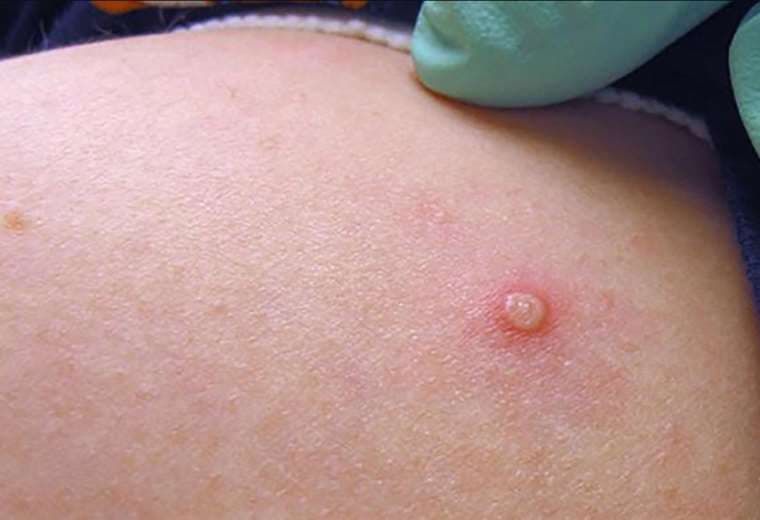 Una pseudopústula es uno de los síntomas que se presentan por esta enfermedad (Infobae)