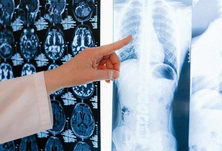 Radiografía de pulmones de un enfermo con cáncer/Foto: Pharma Jonpi