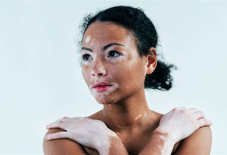 Vitiligo, la enfermedad de la piel que a pesar de ser común es muy poco conocida
