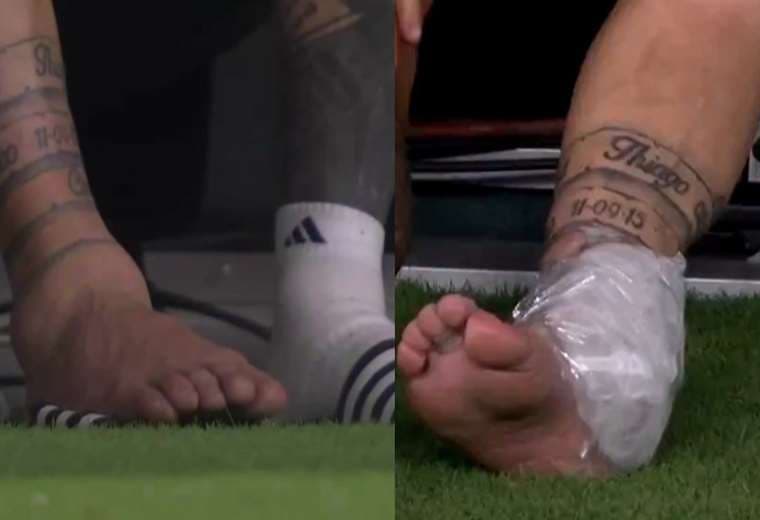 Así lucía el tobillo de Messi el día de la final de la Copa América. Foto: Internet