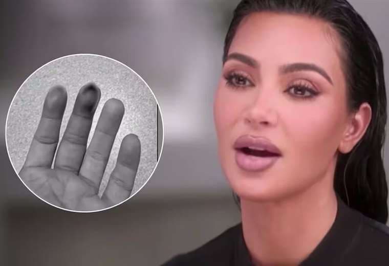 Kim Kardashian revela que sufrió una fractura en la mano