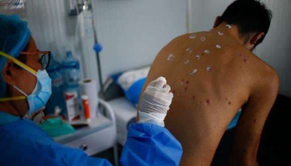 La OMS declara al mpox como nueva emergencia de salud pública internacional