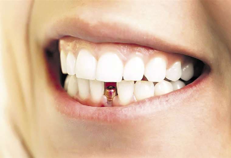 Implante. Es una alternativa para quien perdió piezas dentales