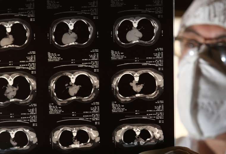 Así son las radiografías para saber si las personas están contagiadas. Foto: Jorge Ibáñez 