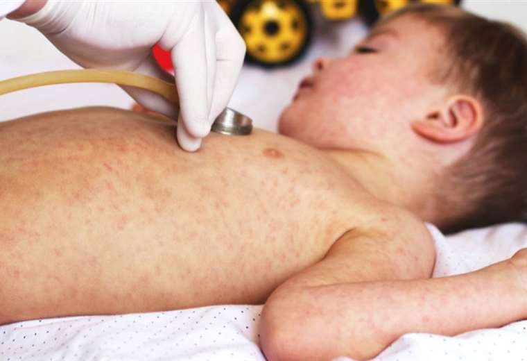 En el país la vacunación contra el sarampión es gratuita