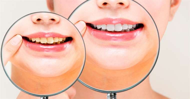 El color de las manchas en los dientes proporciona información sobre su origen y remedio