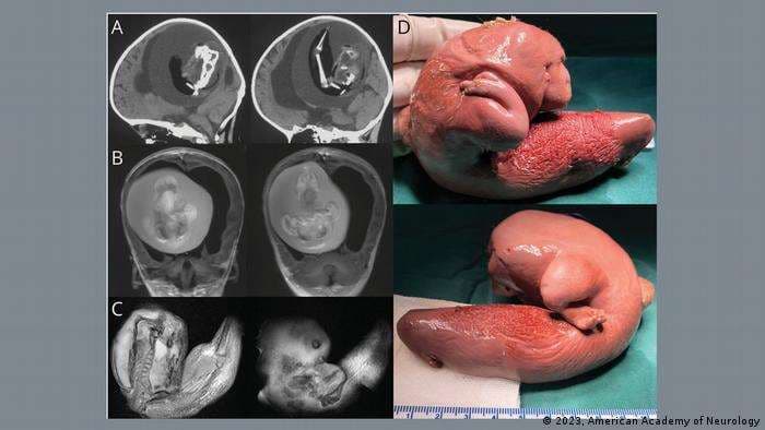Imagen real del caso ocurrido en China conocido como la anomalía "feto en feto