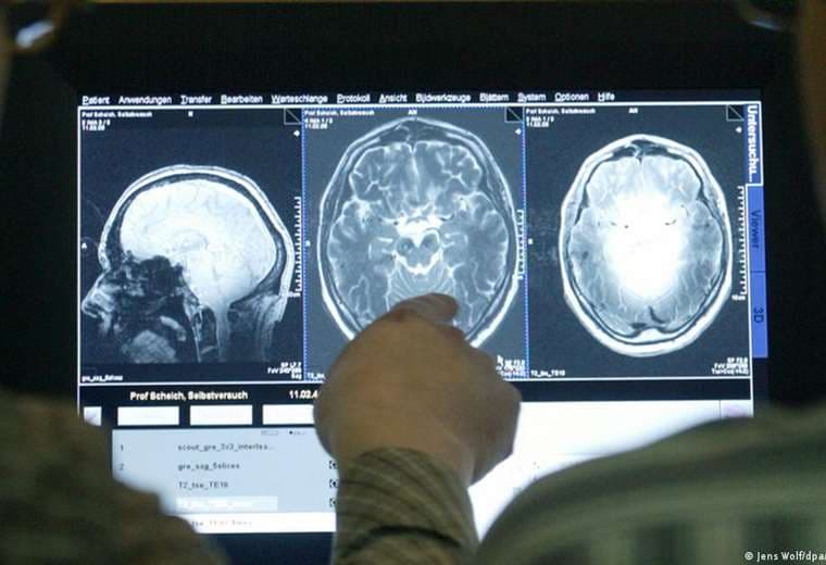 Nuevo medicamento entrega resultados prometedores en tratamiento contra el Alzheimer